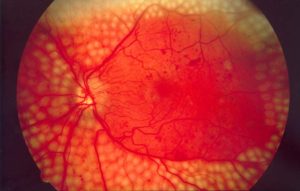 back of eye imaged through panretinal photocoagulation laser